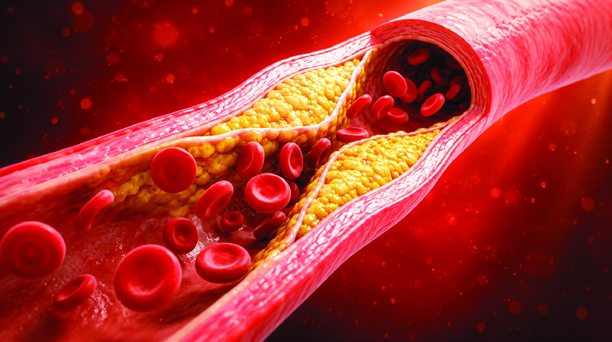 Artery Plaque Render